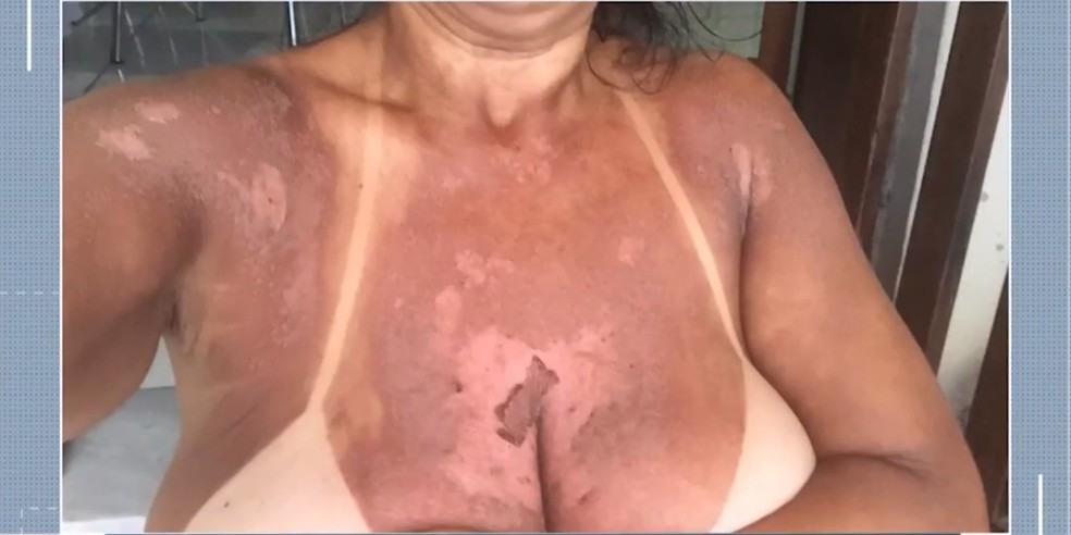 Quatro mulheres denunciam ter sofrido queimaduras apÃ³s serviÃ§o de bronzeamento natural com fitas em clÃ­nica â?? Foto: ReproduÃ§Ã£o/TV Santa Cruz